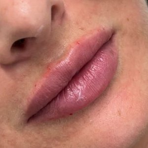Derma Fillers Lips