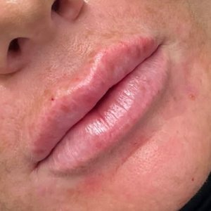 Derma Fillers Lips
